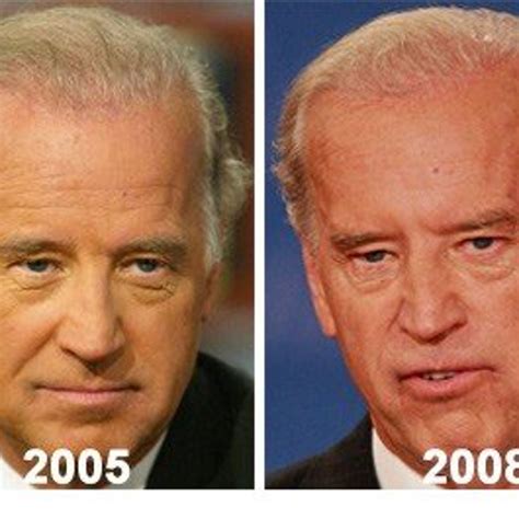 Has Joe Biden Had Plastic Surgery?